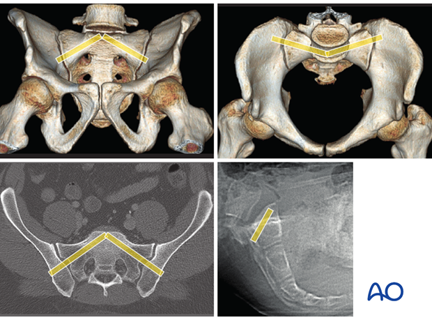 mio iliosacral screw for sacrum