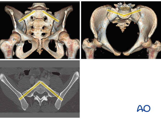 mio iliosacral screw for sacrum