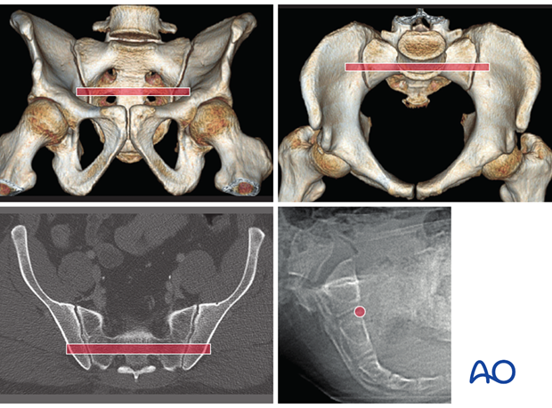 mio iliosacral screw for sacrum