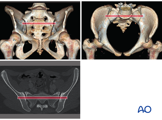 mio iliosacral screw for sacrum