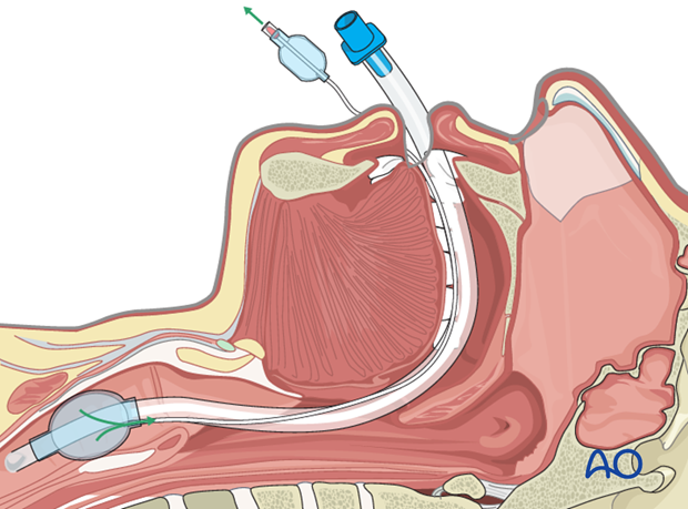 airway