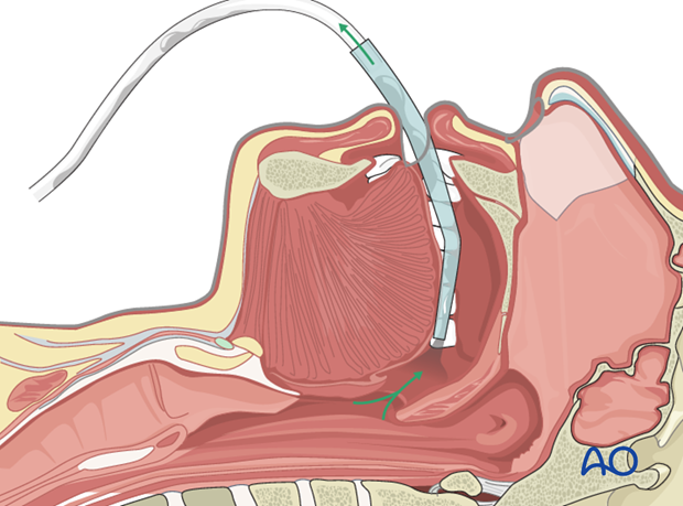 airway