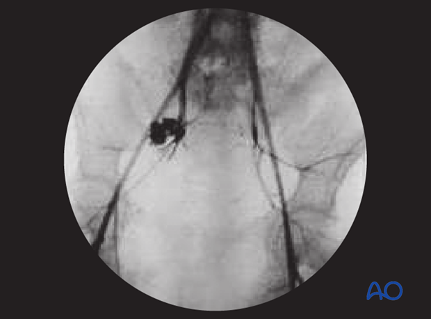 angio embolization