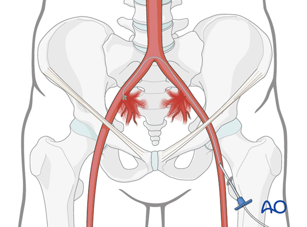 acute pelvic treatment