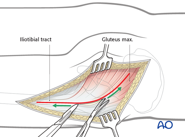 kocher langenbeck approach to the acetabulum