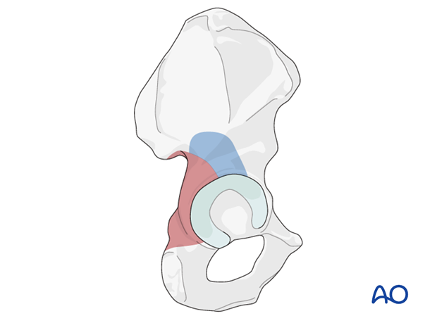 kocher langenbeck approach to the acetabulum