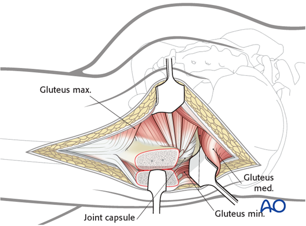 kocher langenbeck approach to the acetabulum