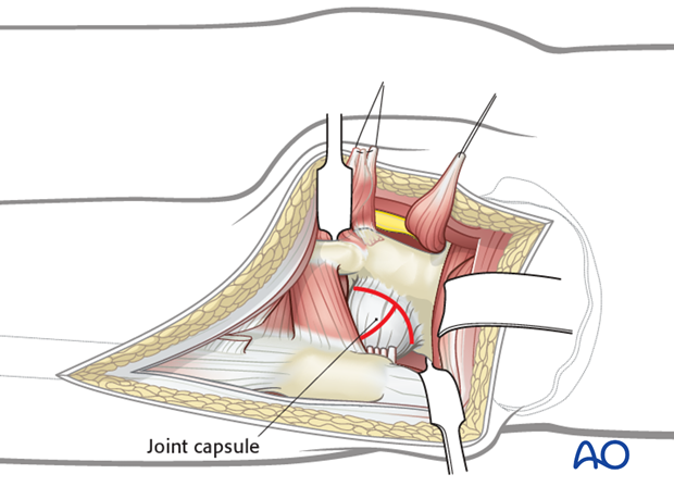 kocher langenbeck approach to the acetabulum