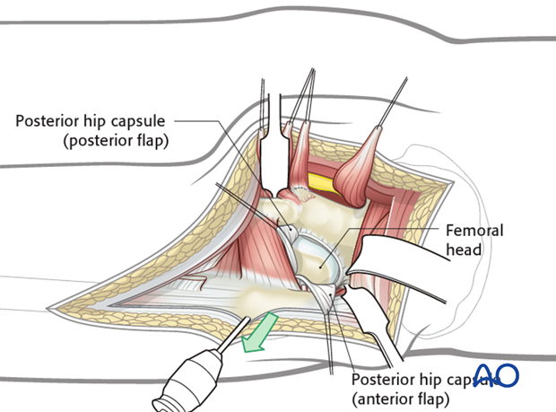 kocher langenbeck approach to the acetabulum