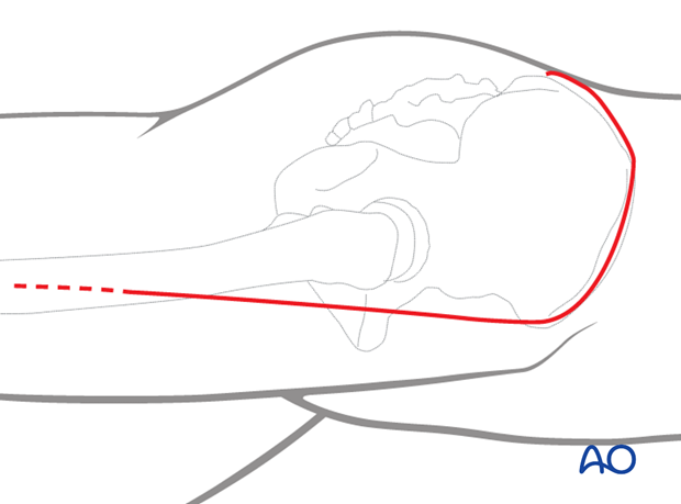 extended iliofemoral approach to the acetabulum