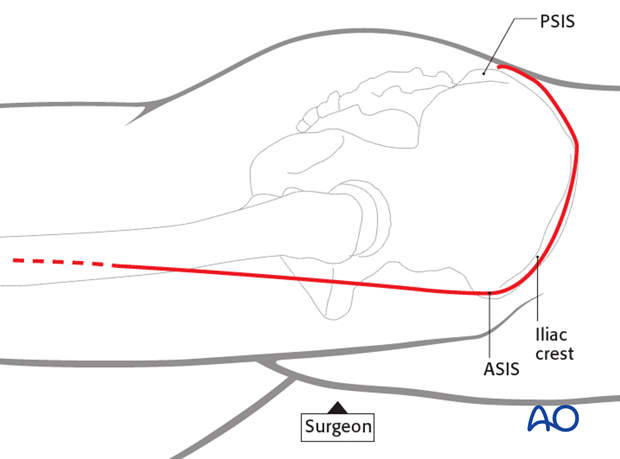 extended iliofemoral approach to the acetabulum