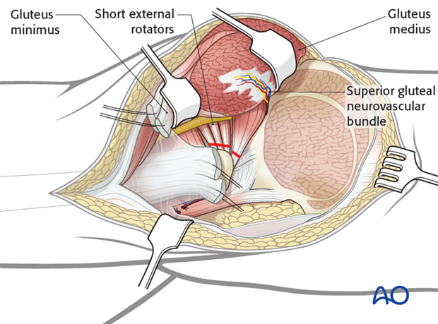 extended iliofemoral approach to the acetabulum