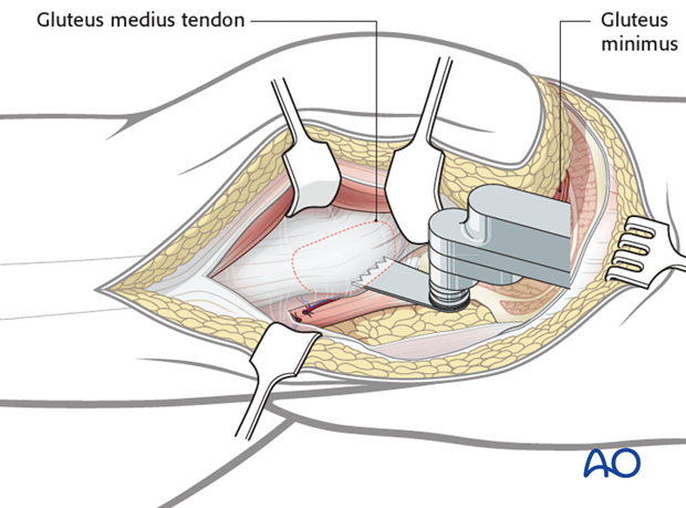 extended iliofemoral approach to the acetabulum