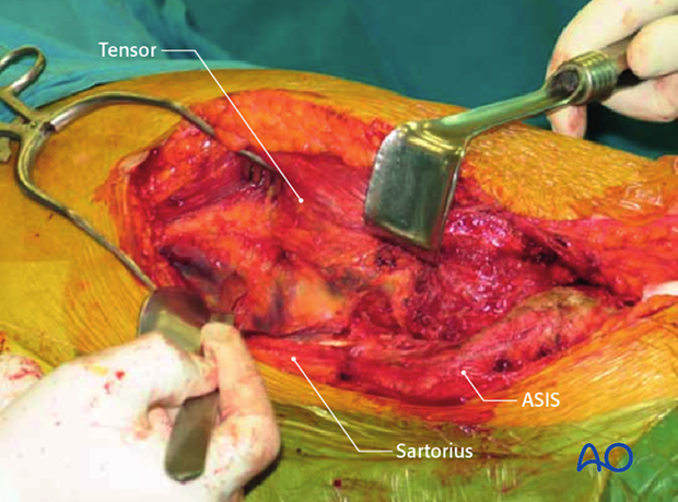 extended iliofemoral approach to the acetabulum