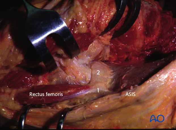 extended iliofemoral approach to the acetabulum