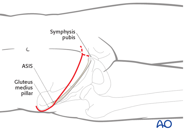 ilioinguinal approach to the acetabulum