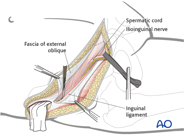 ilioinguinal approach to the acetabulum