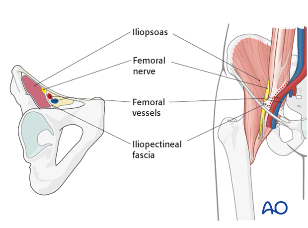 ilioinguinal approach to the acetabulum