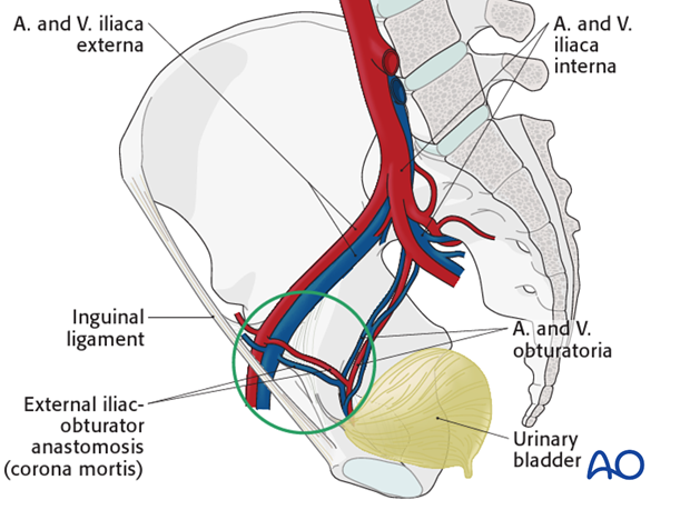 ilioinguinal approach to the acetabulum