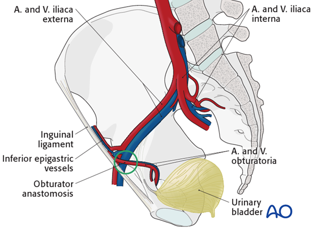 ilioinguinal approach to the acetabulum