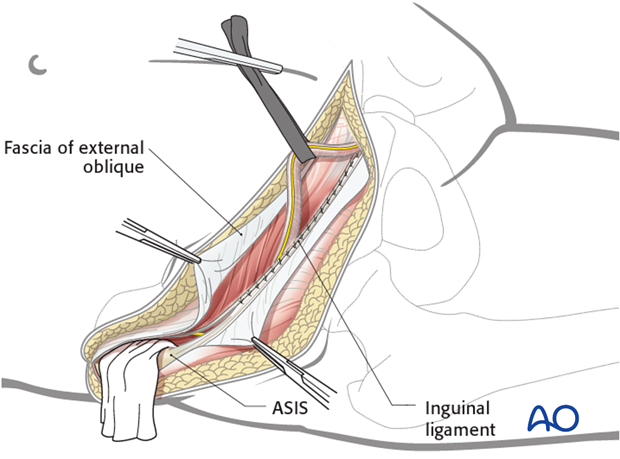 orif through ilioinguinal approach