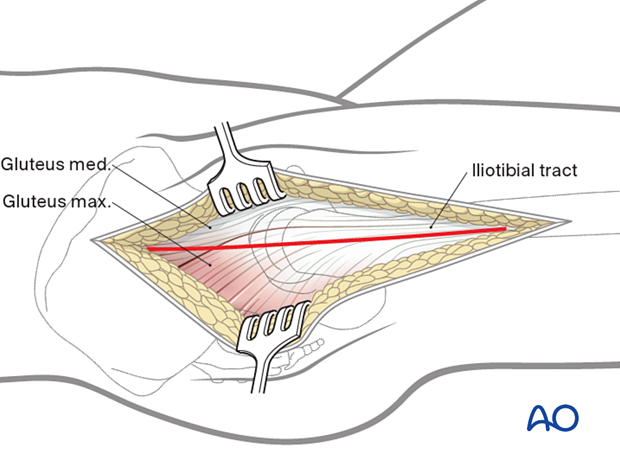 Deepen the incision through subcutaneous fat. The Gibson interval between the gluteus maximus and medius must be delineated.