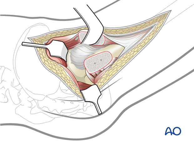 Exposure of the anterior capsule requires mobilization of the proximal portion of the vastus intermedius.