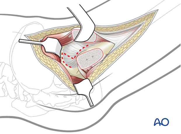 Intraarticular visualization is provided by a Z-shaped capsulotomy. The capsular incision must remain anterior to the lesser trochanter to avoid damaging the medial femoral circumflex artery.