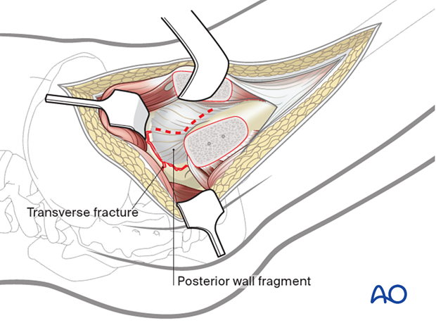 When a posterior wall fracture is present, the capsular pedicle to the wall fragments must be preserved. The capsulotomy is modified to incorporate the posterior wall at its margin.