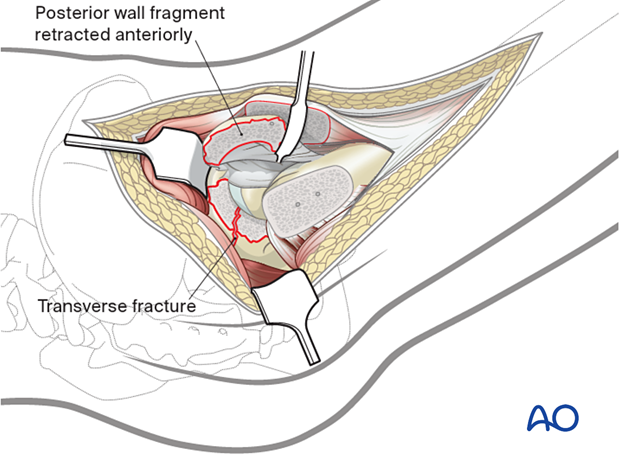 Reflect the posterior wall fragment