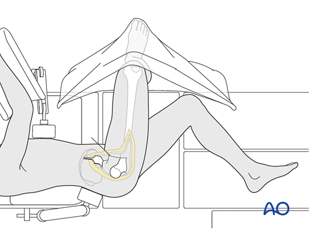 More complex fracture patterns may require extension of this approach to include anterior surgical dislocation.