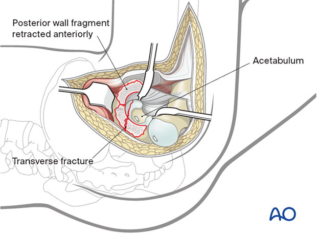 The extension of the transverse fracture through the anterior column can be directly visualized as the femoral head has been dislocated posteriorly.