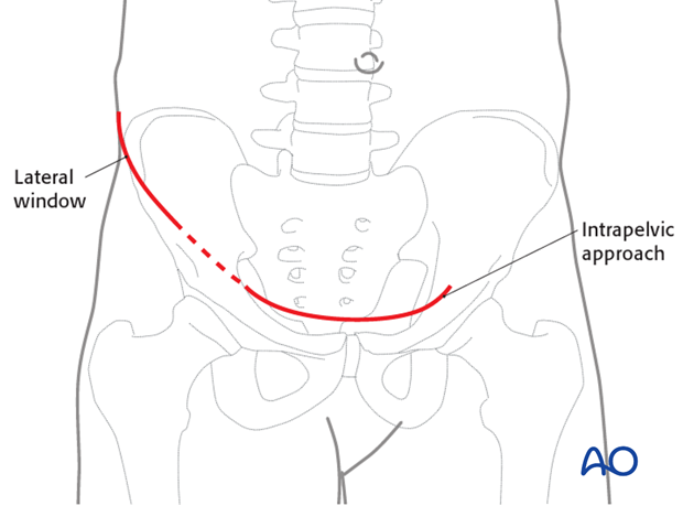 modified stoppa approach