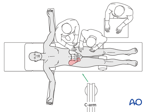 modified stoppa approach