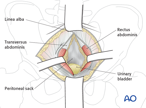 modified stoppa approach