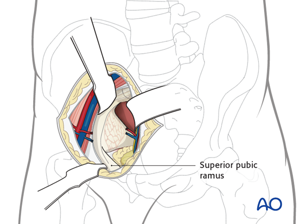 modified stoppa approach