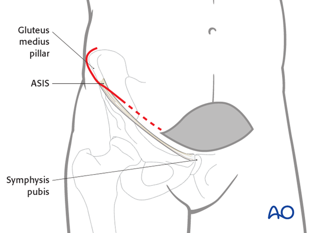 modified stoppa approach