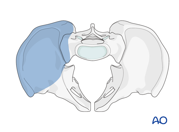 modified stoppa approach