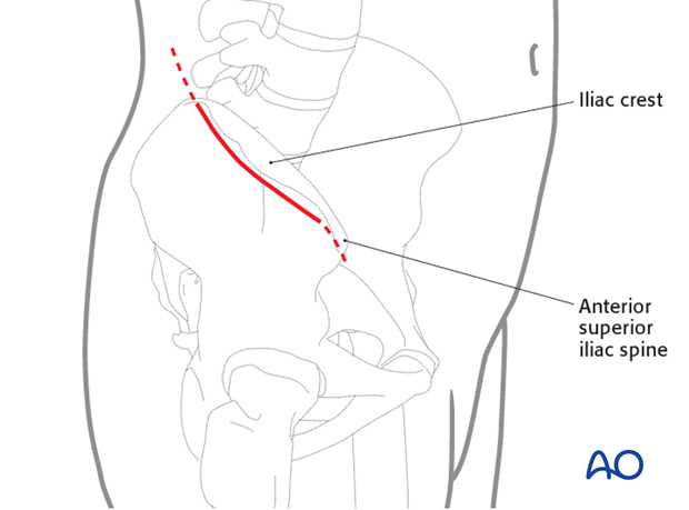 modified stoppa approach