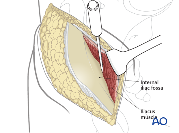 modified stoppa approach