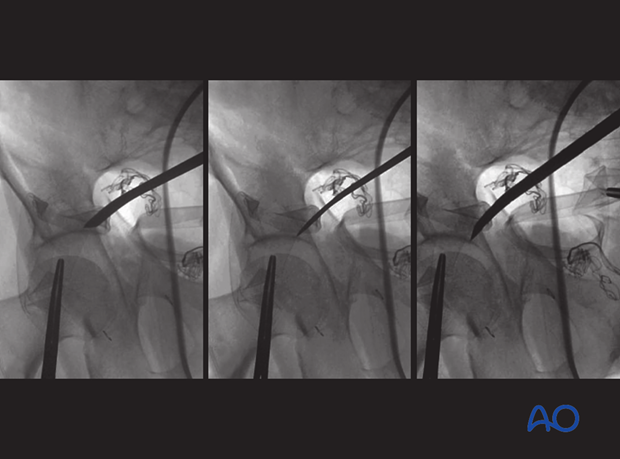 orif through ilioinguinal approach