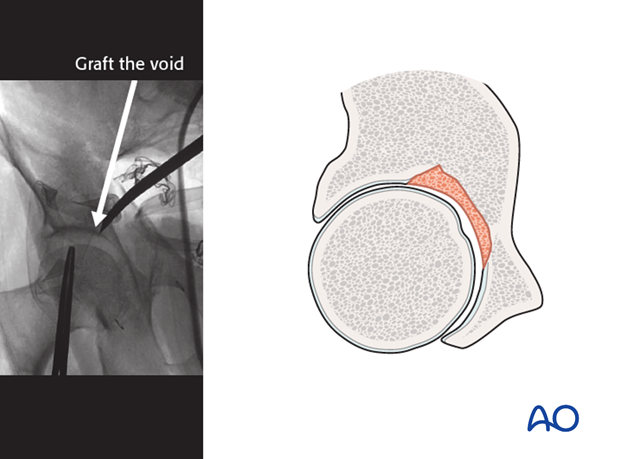 orif through ilioinguinal approach