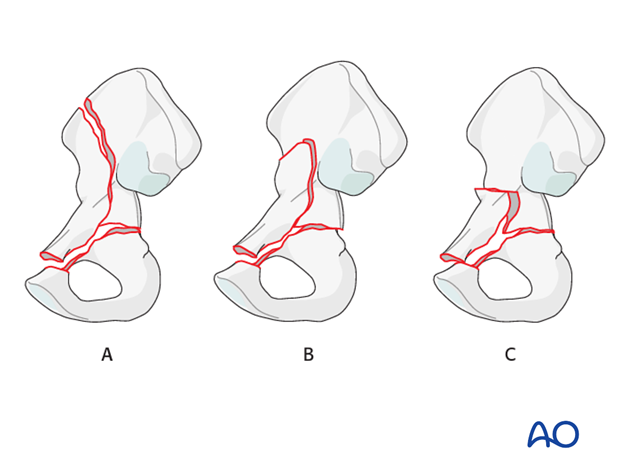 orif through ilioinguinal approach