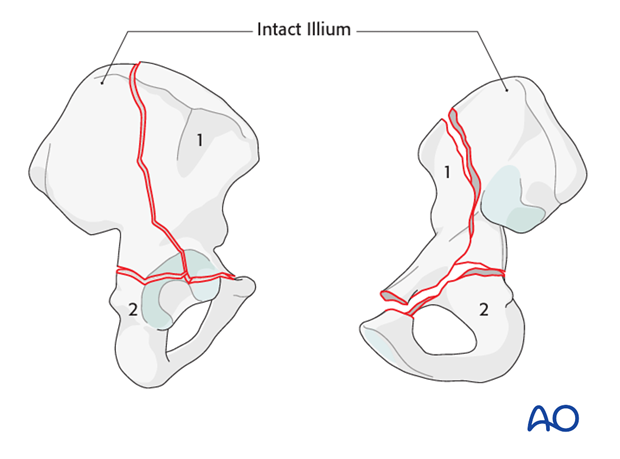 orif through ilioinguinal approach