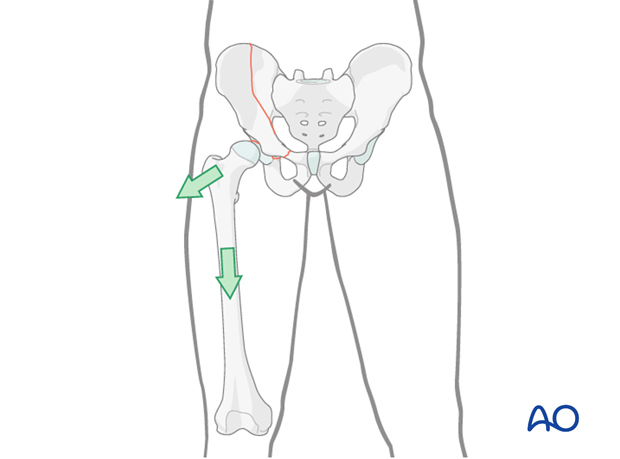 orif through ilioinguinal approach