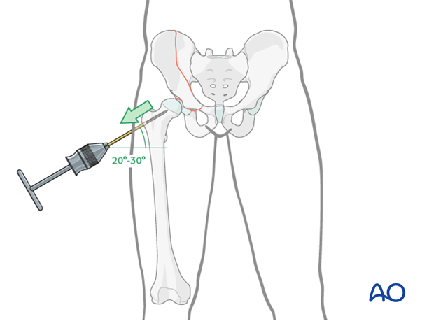 orif through ilioinguinal approach