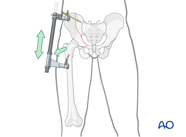 orif through ilioinguinal approach