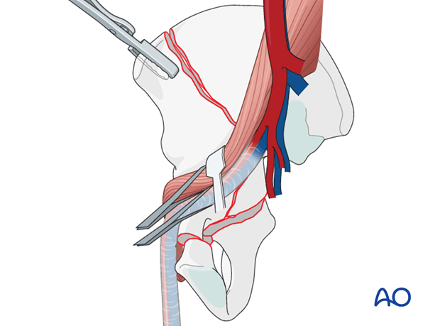 orif through ilioinguinal approach