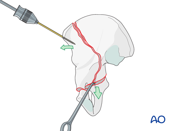 orif through ilioinguinal approach