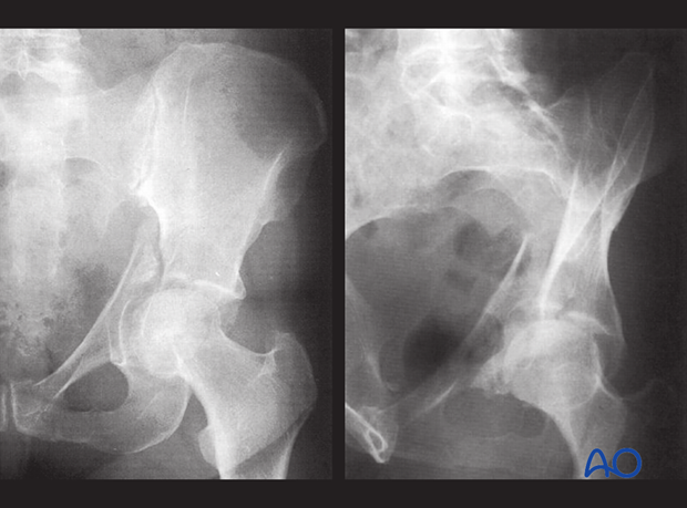 orif through ilioinguinal approach